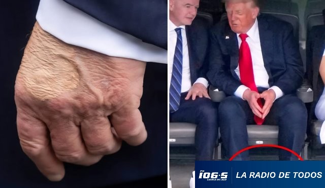 TRUMP VENAS