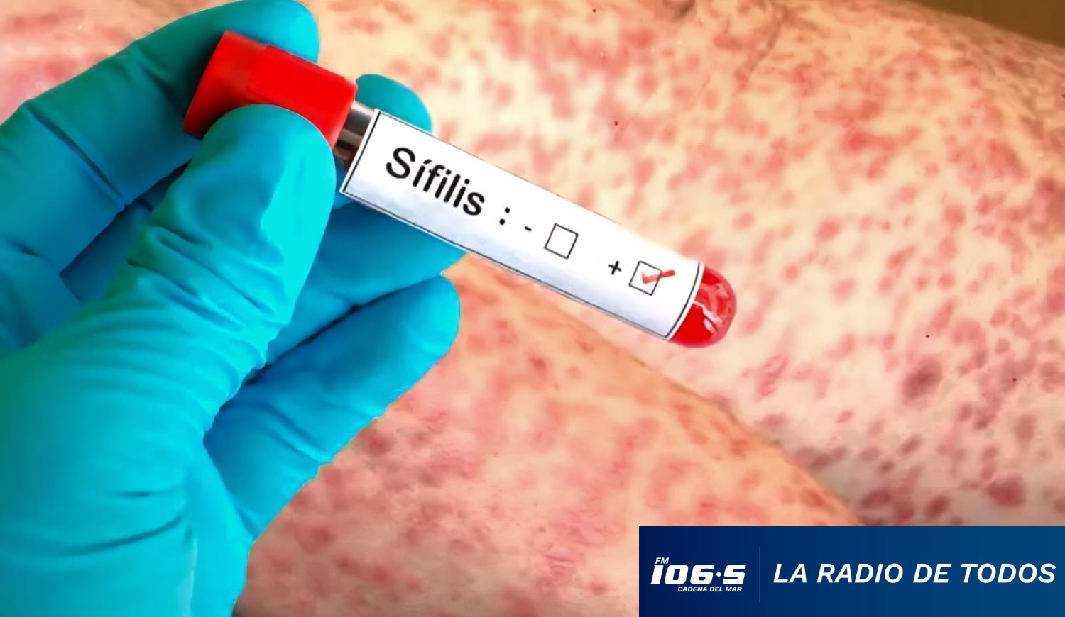 sífilis-msp