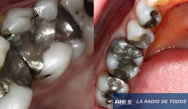 Mercurio dientes